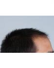 Before Hair Transplant&nbsp;Front