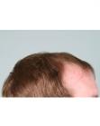 Before Hair Transplant&nbsp;Hairlines