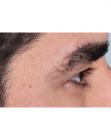 Before Hair Transplant &nbsp;Eyebrows