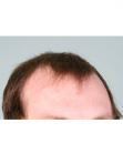 Before Hair Transplant&nbsp;Hairlines