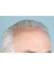 Before Hair Transplant&nbsp;Hairlines