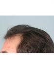 Before Hair Transplant&nbsp;Hairlines