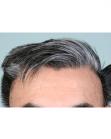 Before Hair Transplant &nbsp;Temporal Hairline