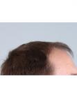 Before Hair Transplant&nbsp;Front
