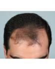 Before Hair Transplant&nbsp;Front