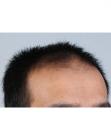 Before Hair Transplant&nbsp;Front