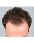 Before Hair Transplant&nbsp;Temporal Hairline