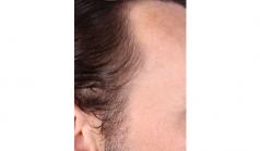 Before Hair Transplant&nbsp;Temporal Hairline