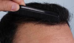 Before Hair Transplant&nbsp;2 Sessions (Areas)