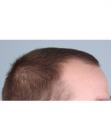 Before Hair Transplant&nbsp;Front