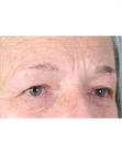 Before Hair Transplant &nbsp;Eyebrows