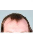 Before Hair Transplant &nbsp;Hairlines