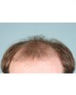 Before Hair Transplant &nbsp;Front