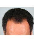 Before Hair Transplant&nbsp;Hairlines