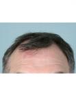 Before Hair Transplant&nbsp;Front