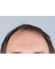 Before Hair Transplant &nbsp;Front