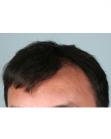 Before Hair Transplant&nbsp;Front