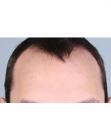 Before Hair Transplant&nbsp;Hairlines