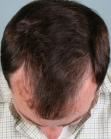 Before Hair Transplant&nbsp;Hairlines