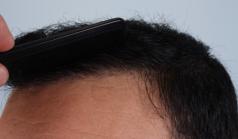 Before Hair Transplant&nbsp;2 Sessions (Areas)