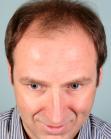 Before Hair Transplant&nbsp;Front