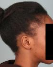 Before Hair Transplant&nbsp;Traction Alopecia