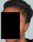 Before Hair Transplant  Traction Alopecia