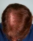 Before Hair Transplant&nbsp;Hair Thinning
