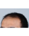 Before Hair Transplant&nbsp;Front
