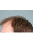 Before Hair Transplant&nbsp;Front
