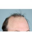 Before Hair Transplant&nbsp;Revision
