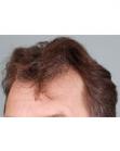 Before Hair Transplant&nbsp;Hairlines
