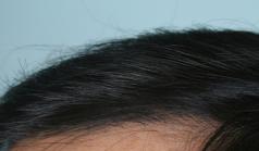 Before Hair Transplant&nbsp;2 Sessions (Areas)