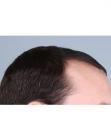 Before Hair Transplant&nbsp;Hairlines