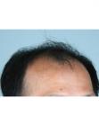 Before Hair Transplant&nbsp;2 Sessions (Areas)