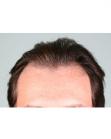 Before Hair Transplant &nbsp;Front