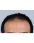 Before Hair Transplant &nbsp;Front