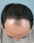 Before Hair Transplant&nbsp;Front