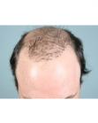 Before Hair Transplant&nbsp;Revision