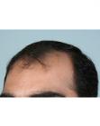 Before Hair Transplant&nbsp;Front