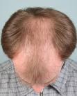 Before Hair Transplant&nbsp;Front