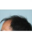 Before Hair Transplant&nbsp;2 Sessions (Areas)
