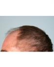 Before Hair Transplant&nbsp;Front