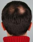 Before Hair Transplant &nbsp;Crown