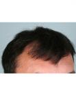 Before Hair Transplant&nbsp;Front