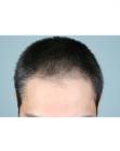 Before Hair Transplant&nbsp;Front