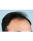 Before Hair Transplant&nbsp;Hairlines