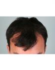 Before Hair Transplant&nbsp;Front