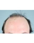 Before Hair Transplant &nbsp;Revision