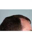 Before Hair Transplant&nbsp;Hairlines
